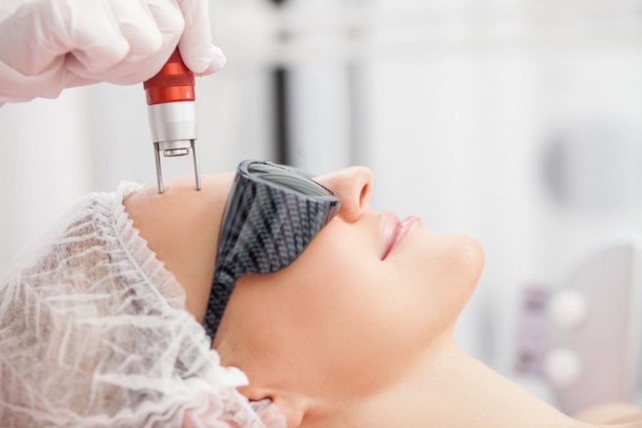 Sessão de peeling e laser facial